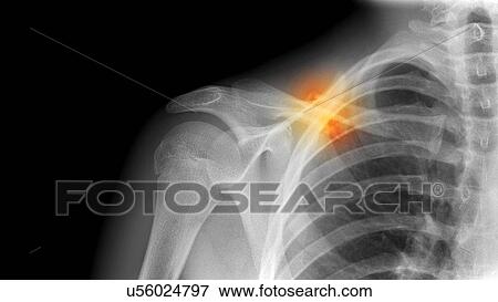 Stock Photo - Fractured collarbone, X-ray. Fotosearch