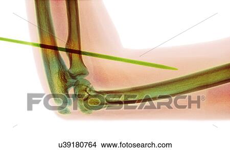 Picture - Knitting needle through arm, X-ray. Fotosearch