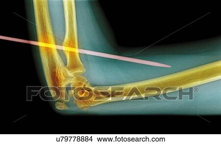 Picture - Knitting needle through arm, X-ray. Fotosearch