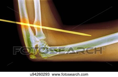 Stock Image - Knitting needle through arm, X-ray. Fotosearch
