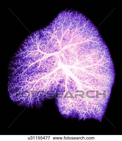 Stock Photo - Lung, X-ray. Fotosearch