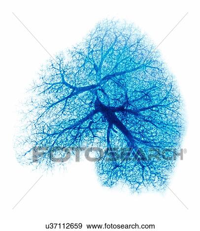 Lung, X-ray View Large Photo Image Stock Photo - Lung, X-ray. Fotosearch