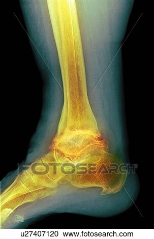 Stock Image - Osteoarthritis of the ankle, X-ray. Fotosearch