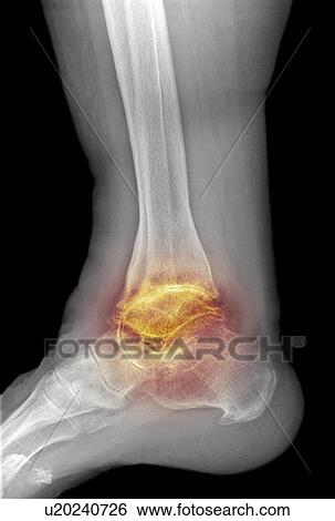 Osteoarthritis of the ankle, X-ray View Large Photo Image Stock Photograph - Osteoarthritis of the ankle, X-ray. Fotosearch