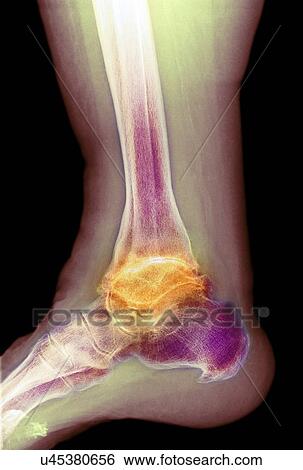 Stock Photograph - Osteoarthritis of the ankle, X-ray. Fotosearch
