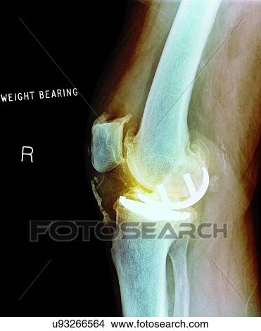 Picture - Osteoarthritis of the knee, X-ray. Fotosearch