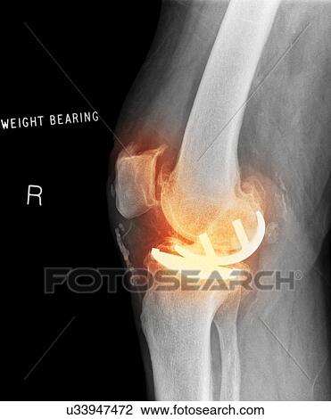 Osteoarthritis of the knee, X-ray View Large Photo Image Stock Image - Osteoarthritis of the knee, X-ray. Fotosearch