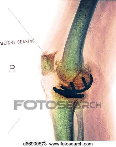 Osteoarthritis of the knee, X-ray View Large Photo Image Stock Image - Osteoarthritis of the knee, X-ray. Fotosearch