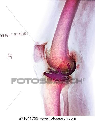 Osteoarthritis of the knee, X-ray View Large Photo Image Stock Photography - Osteoarthritis of the knee, X-ray. Fotosearch