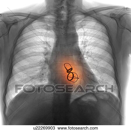 Stock Image - Prosthetic heart valves, X-ray. Fotosearch
