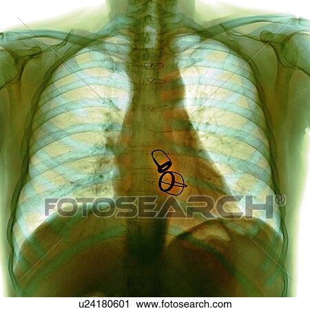 Prosthetic heart valves, X-ray View Large Photo Image Stock Image - Prosthetic heart valves, X-ray. Fotosearch