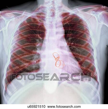 Stock Image - Prosthetic heart valves, X-ray. Fotosearch
