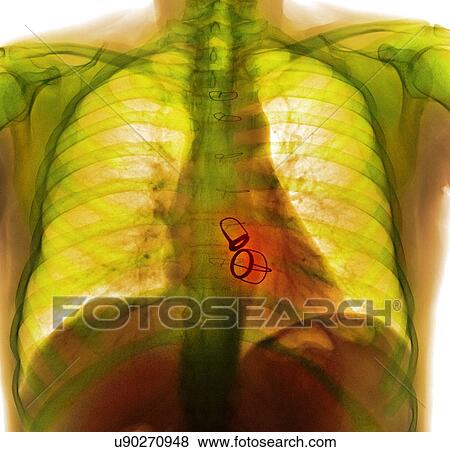 Stock Photo - Prosthetic heart valves, X-ray. Fotosearch
