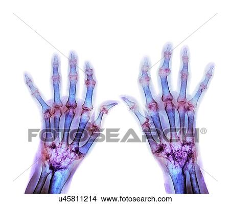 Rheumatoid arthritis, X-ray View Large Photo Image Picture - Rheumatoid arthritis, X-ray. Fotosearch