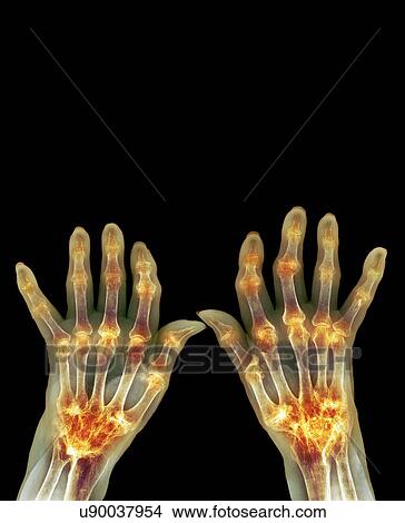 Rheumatoid arthritis, X-ray View Large Photo Image Picture - Rheumatoid arthritis, X-ray. Fotosearch