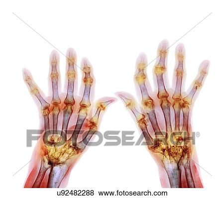 Stock Photo - Rheumatoid arthritis, X-ray. Fotosearch