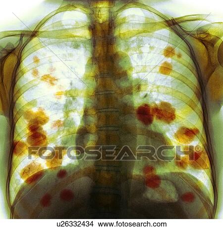 Picture - Secondary lung cancer, X-ray. Fotosearch