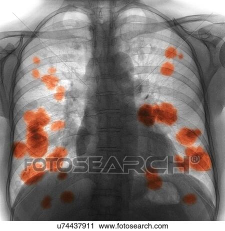 Stock Image - Secondary lung cancer, X-ray. Fotosearch