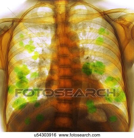Stock Photograph - Secondary lung cancer, X-ray. Fotosearch
