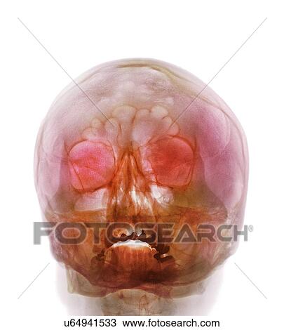 Shotgun injury, X-ray View Large Photo Image Stock Image - Shotgun injury, X-ray. Fotosearch