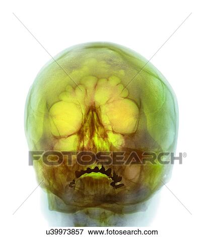 Shotgun injury, X-ray View Large Photo Image Stock Photo - Shotgun injury, X-ray. Fotosearch