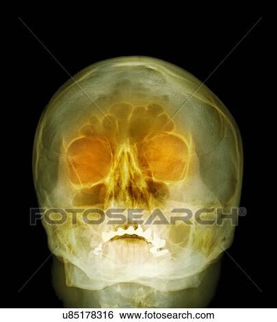 Stock Photograph - Shotgun injury, X-ray. Fotosearch