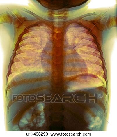 Stock Image - Swallowed coins, X-ray. Fotosearch