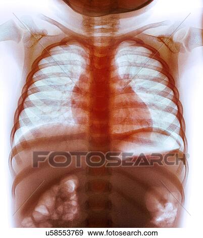 Swallowed coins, X-ray View Large Photo Image Stock Photo - Swallowed coins, X-ray. Fotosearch