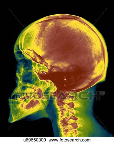 Stock Image - Skull, X-ray. Fotosearch