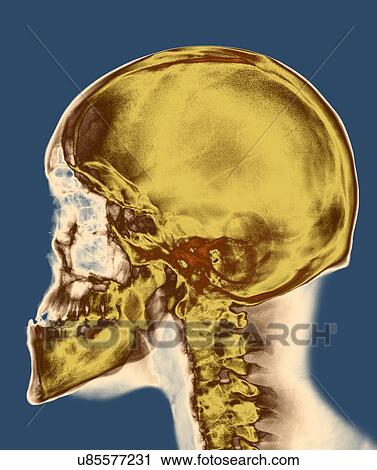 Skull, X-ray View Large Photo Image Stock Image - Skull, X-ray. Fotosearch