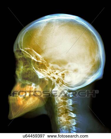 Stock Photo - Skull, X-ray. Fotosearch