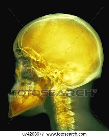 Skull, X-ray View Large Photo Image Stock Photo - Skull, X-ray. Fotosearch