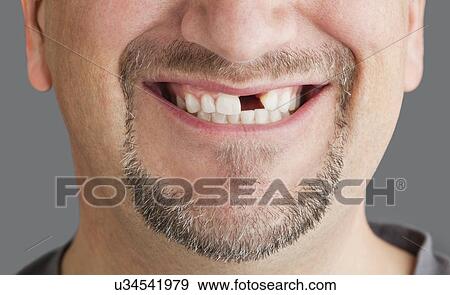 Man with missing front tooth View Large Photo Image Stock Photo - Man with missing front tooth. Fotosearch