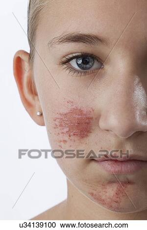 Studio shot of girl (12-13) with scratches and scars on face View Large Photo Image Stock Image - Studio shot of girl (12-13) with scratches and scars on face. Fotosearch