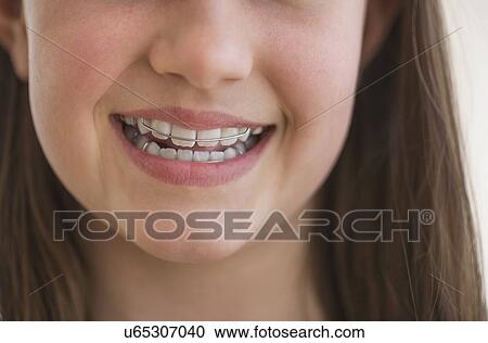 girl (10-11) wearing dental braces smiling View Large Photo Image Stock Image - girl (10-11) wearing dental braces smiling. Fotosearch