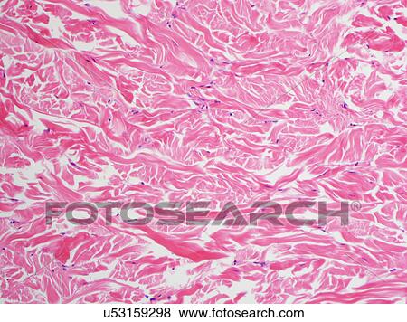 Stock Photo - H&E stain, light microscopy, abundant collagen in a Gardner fibroma. Fotosearch