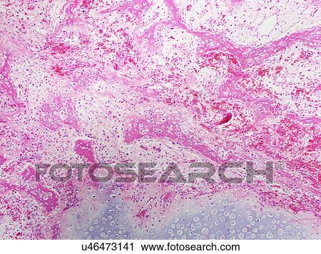 H&E stain, light microscopy, healing fracture callus with exuberant cartilage and new bone formation View Large Photo Image Stock Image - H&E stain, light microscopy, healing fracture callus with exuberant cartilage and new bone formation. Fotosearch