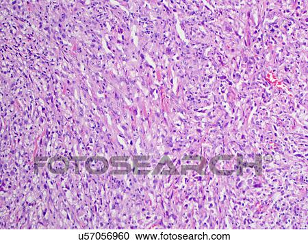 Stock Image - H&E stain, light microscopy, malignant melanoma of skin. Fotosearch