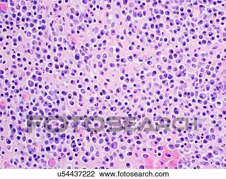 Stock Image - H&E stain, light microscopy, multiple myeloma. Fotosearch