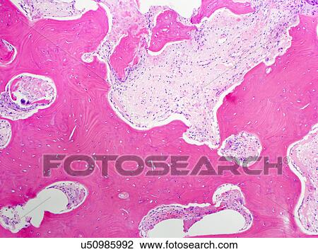 Stock Image - H&E stain, light microscopy, Paget disease of bone. Fotosearch