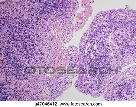 Stock Image - H&E stain, light microscopy, rheumatoid arthritis of joint showing inflammation and hyperplasia. Fotosearch