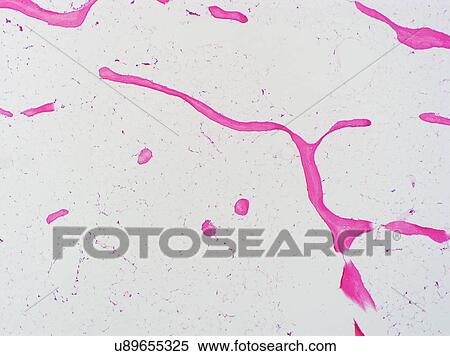 Stock Photography - H&E stain, light microscopy, osteoporosis, bone. Fotosearch
