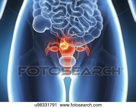 Clip Art - Cancer of the uterus, illustration. Fotosearch