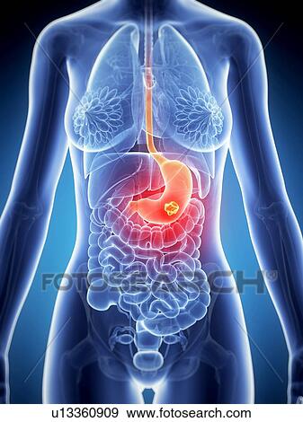 Stock Illustration - Female stomach cancer, illustration. Fotosearch