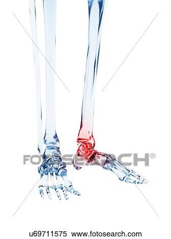 Human ankle pain, illustration View Large Illustration Stock Illustration - Human ankle pain, illustration. Fotosearch