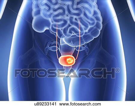 Human bladder cancer, illustration View Large Illustration Clip Art - Human bladder cancer, illustration. Fotosearch