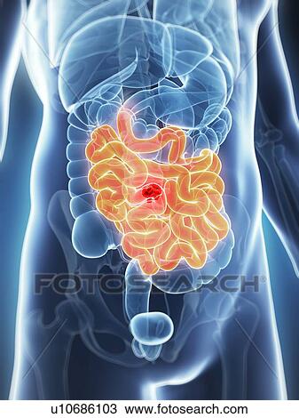 Drawing - Human intestine tumor, illustration. Fotosearch