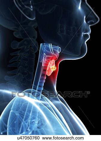 Clipart - Human larynx cancer, illustration. Fotosearch