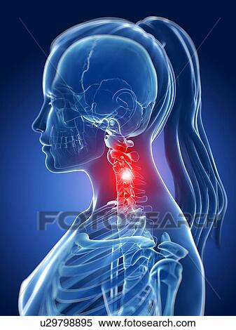 Human neck pain, illustration View Large Illustration Stock Illustration - Human neck pain, illustration. Fotosearch