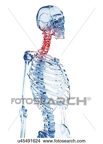Stock Illustration - Human neck pain, illustration. Fotosearch